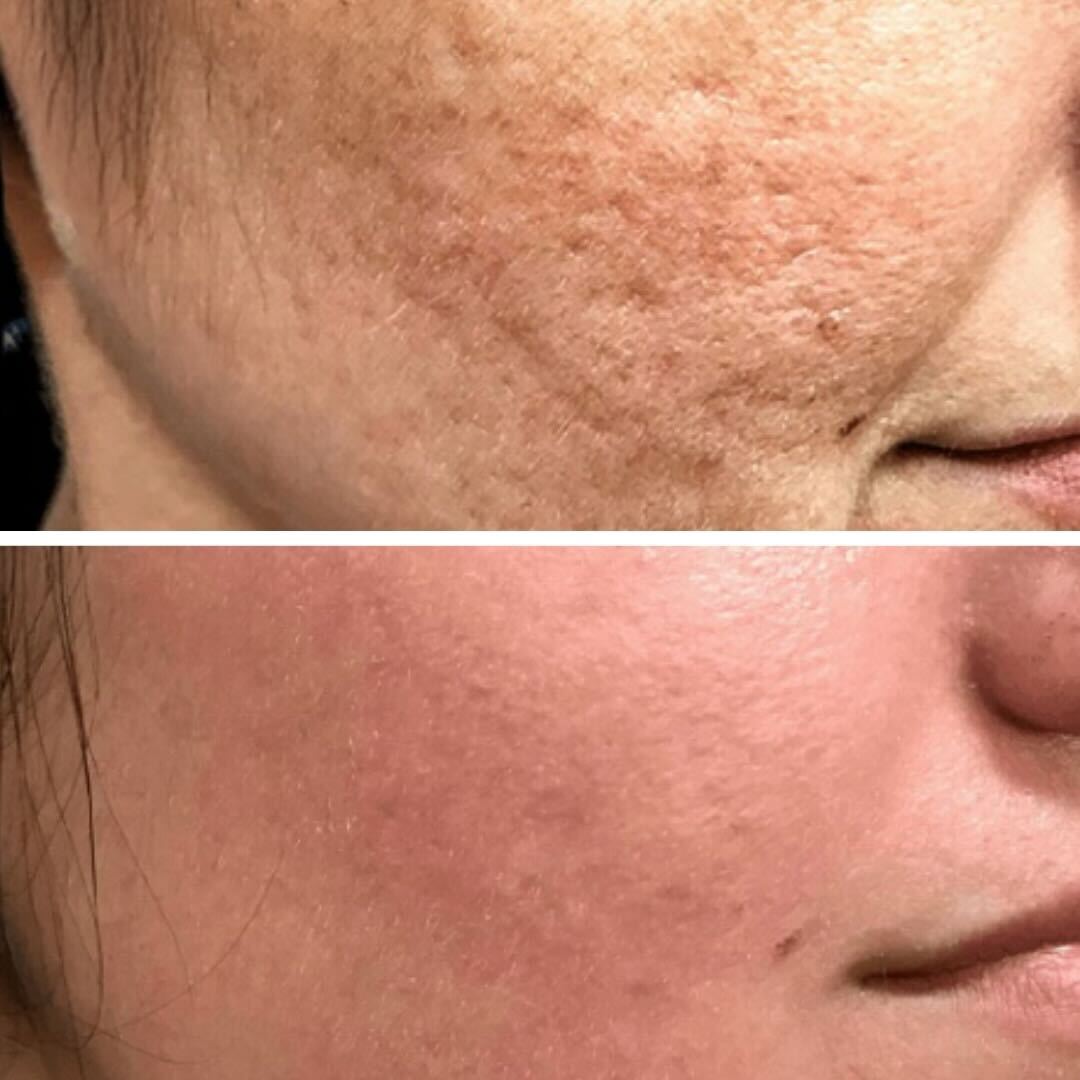Before and after: Treated for fine lines, wrinkles, and skin texture.