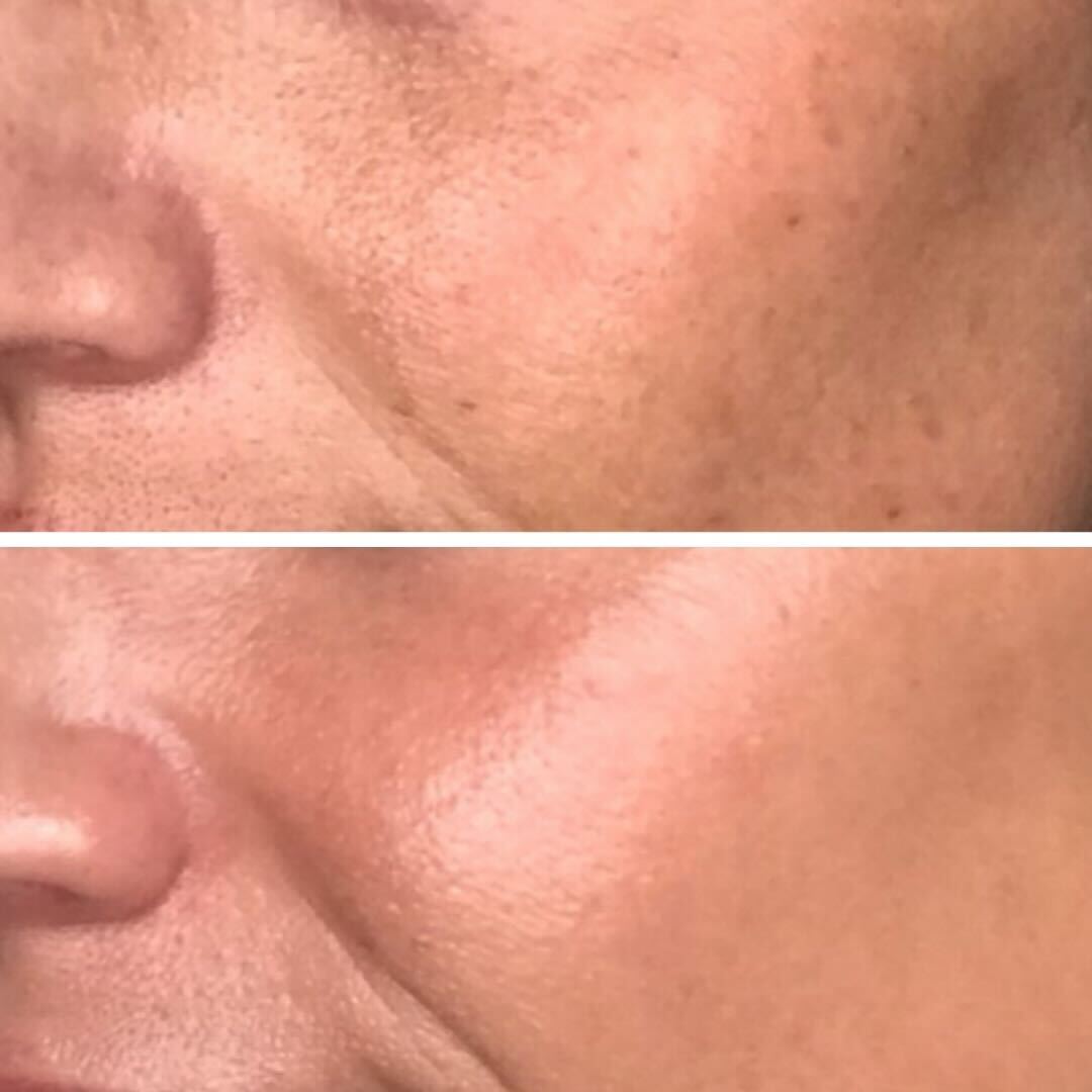 Before and after: Treated for enlarged pores and uneven skin texture.