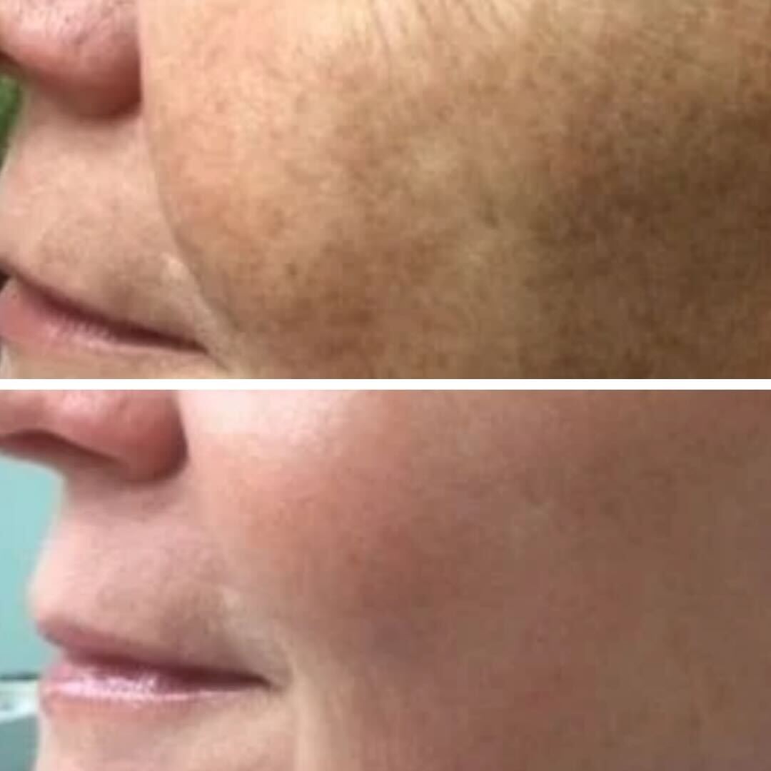 Before and after: Treated for melasma, scarring, and hyperpigmentation.