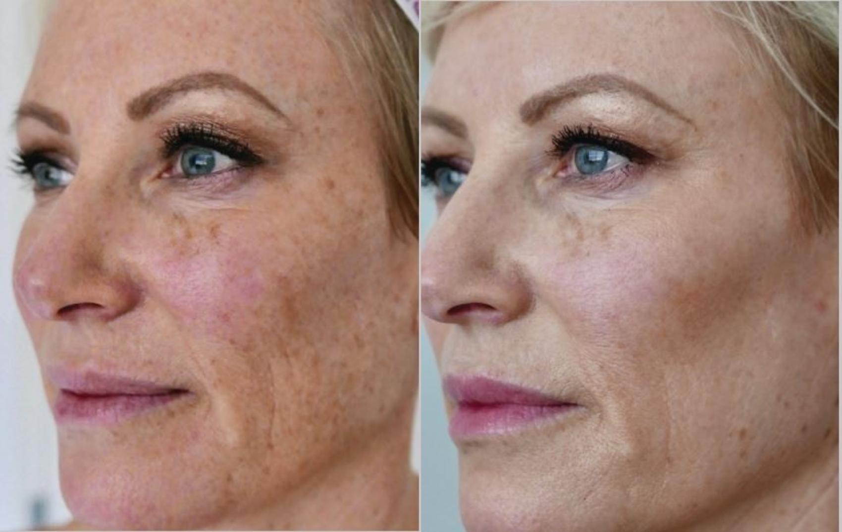 Before and after: Treated for sun damage, freckles, and pigmentation.