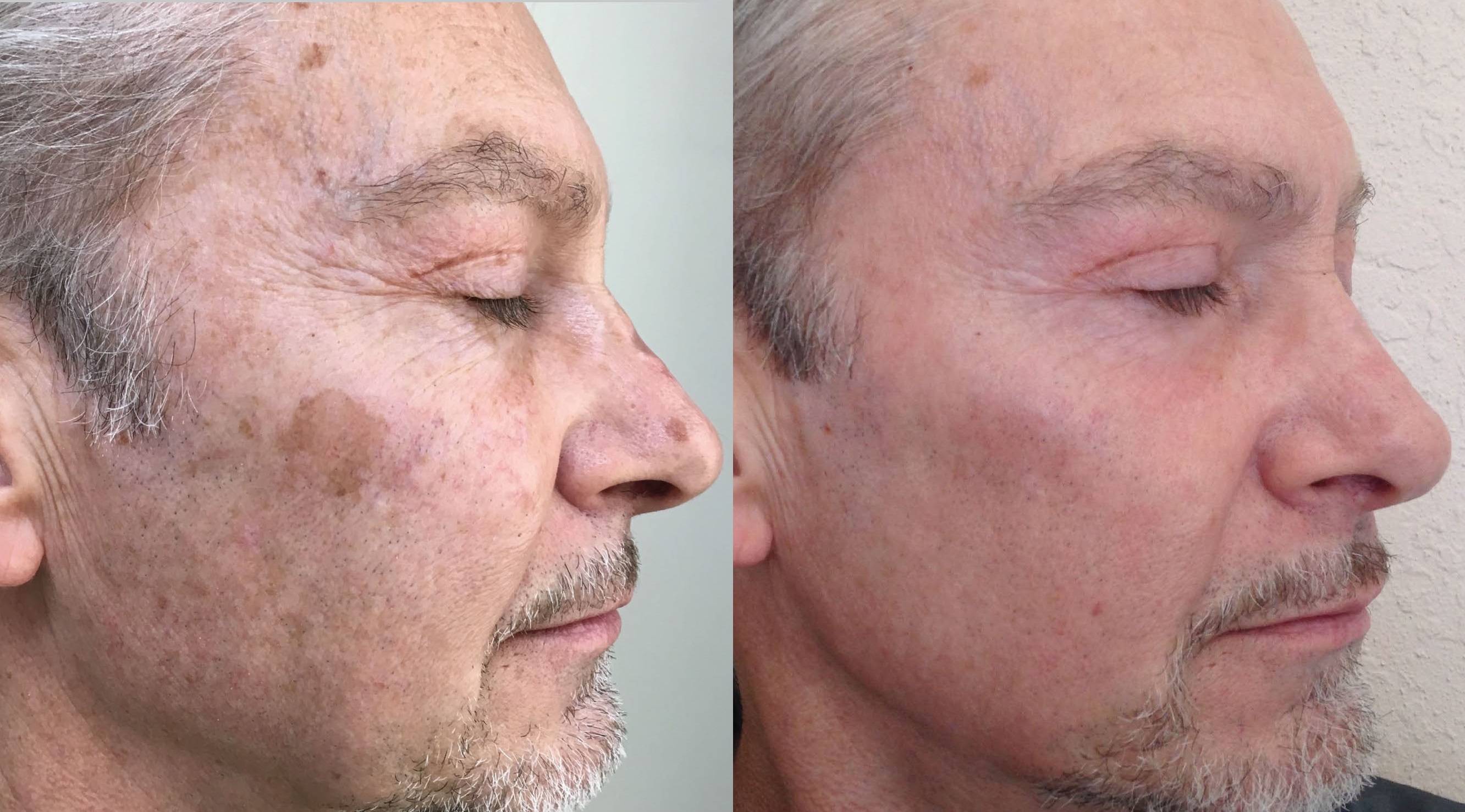 Before and after: Treated for sun spots, hyperpigmentation, and age spots.