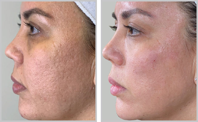 Before and after: Treated for acne scarring and skin texture.