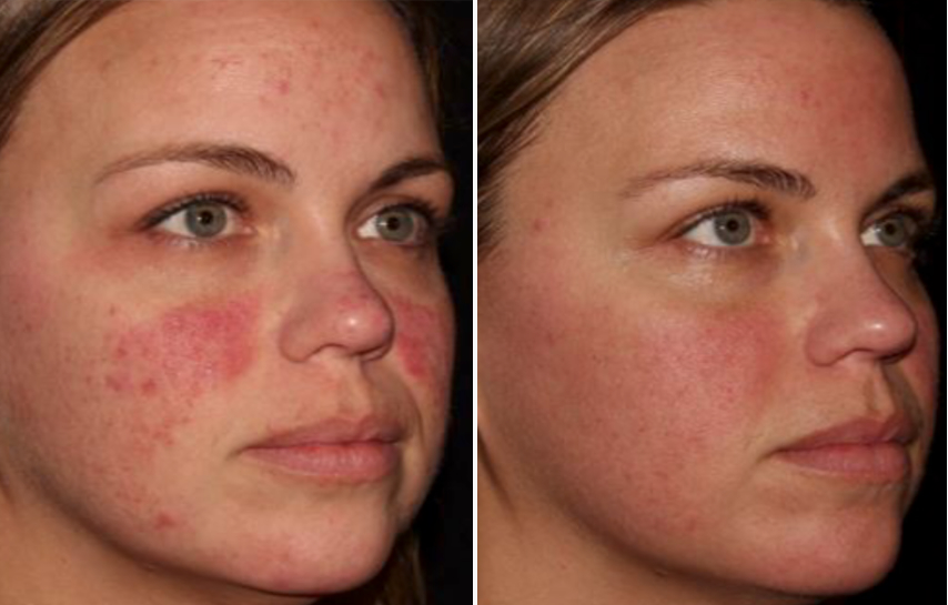 Before and after: Treated for redness, rosacea, and uneven skin tone.